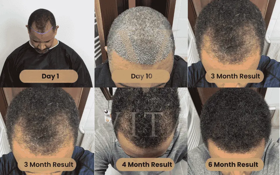 Afro Hair Transplant Results Month by Month