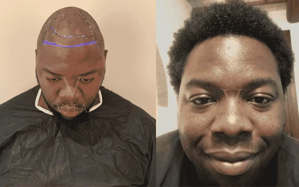 Shock Loss Hair Transplant