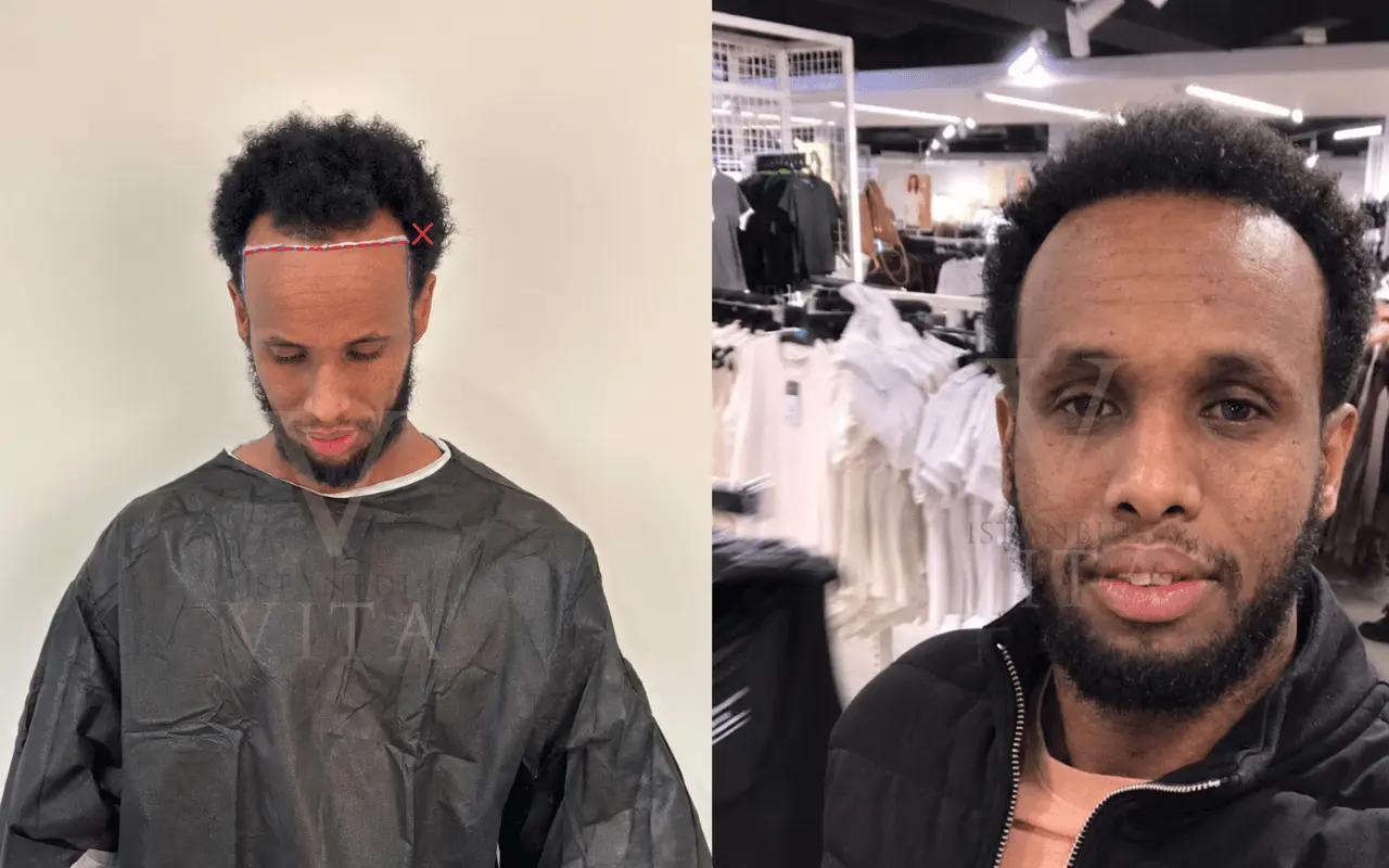 the person with afro hair before and after hair transplant