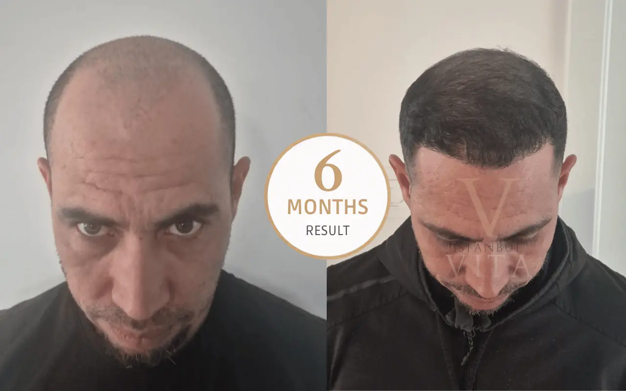 hair transplant 6 months result