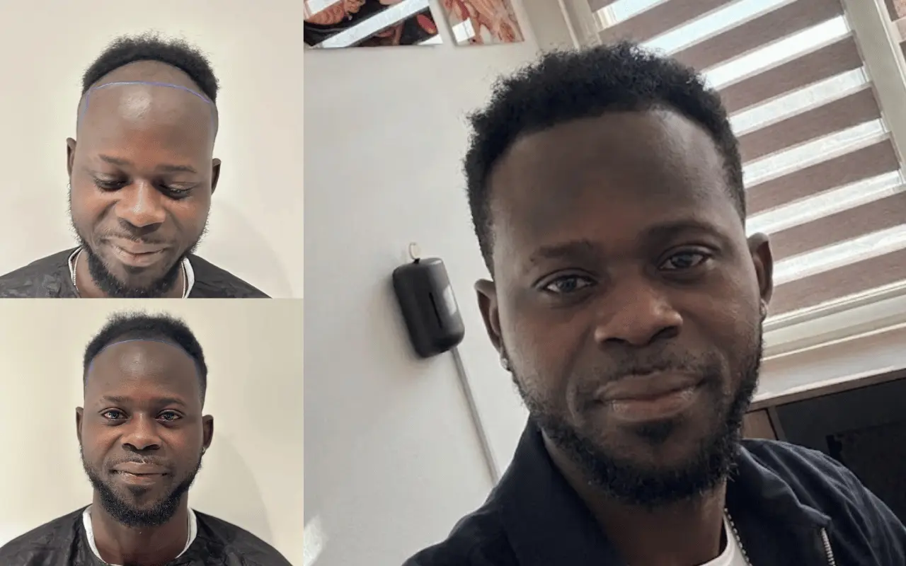 person before and after with afro hair transplant