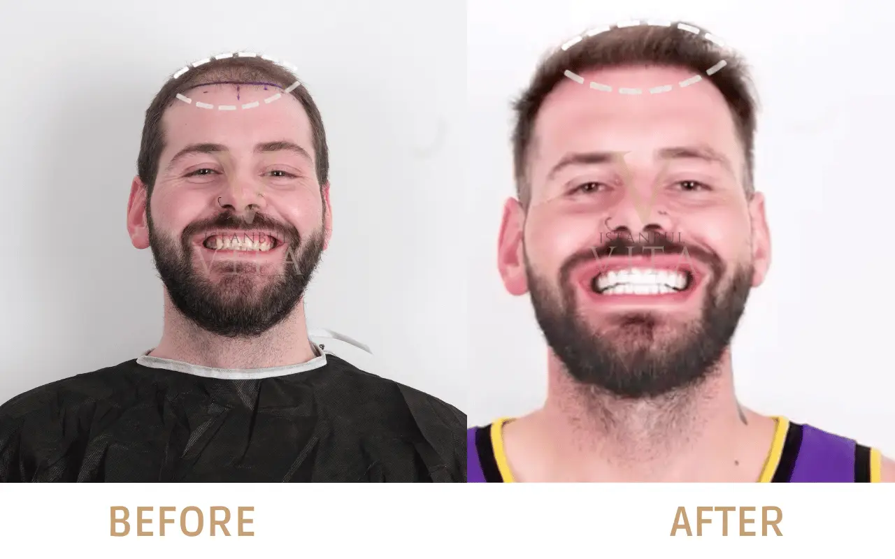 a man with the before and after hair transplant results 