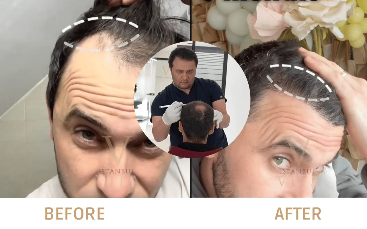 a man and the doctor with the visble hairline transplant pics 