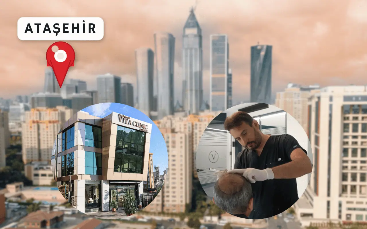 Ataşehir saç ekimi 