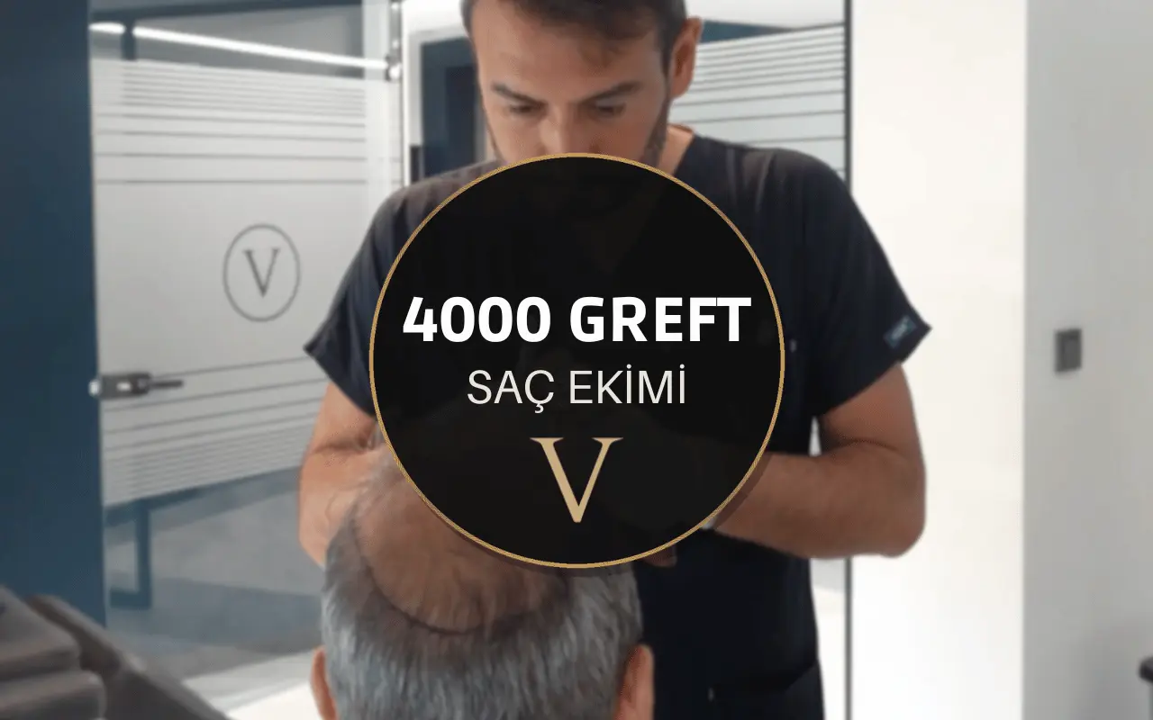 4000 Greft Saç Ekimi