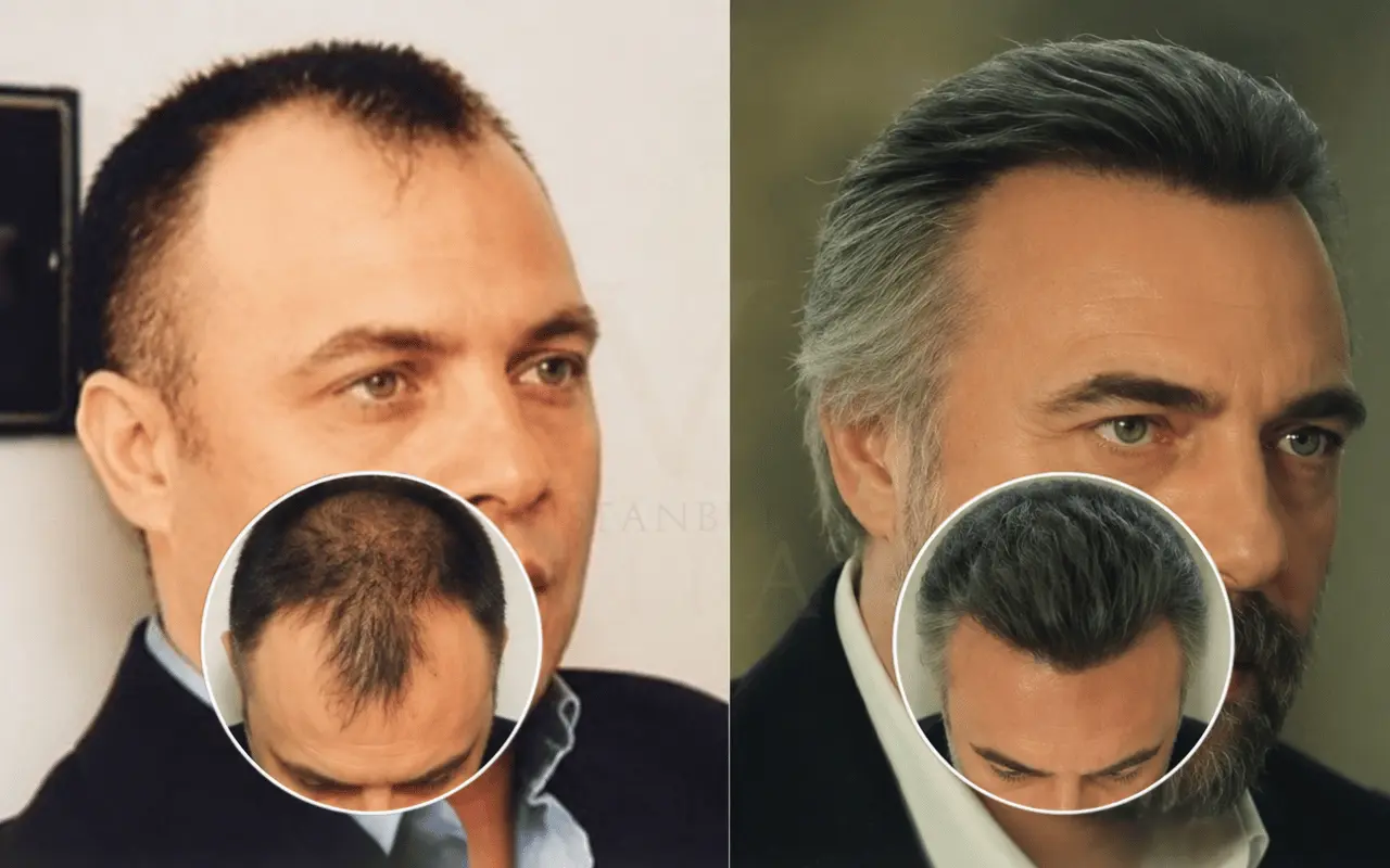 oktay kaynarca saç ekimi yaptır mı? 