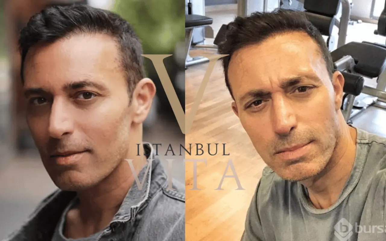 Mustafa Sandal Saç Ekimi