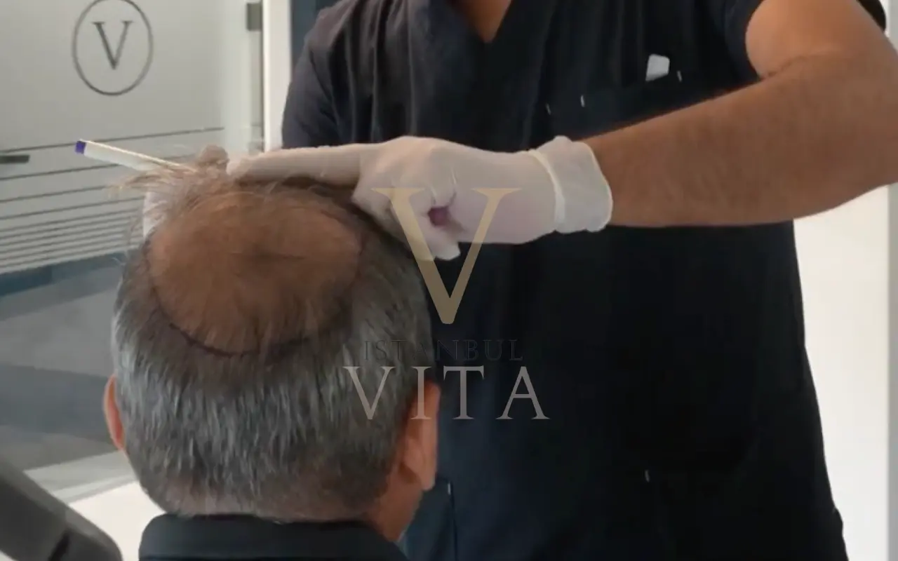 hair transplant