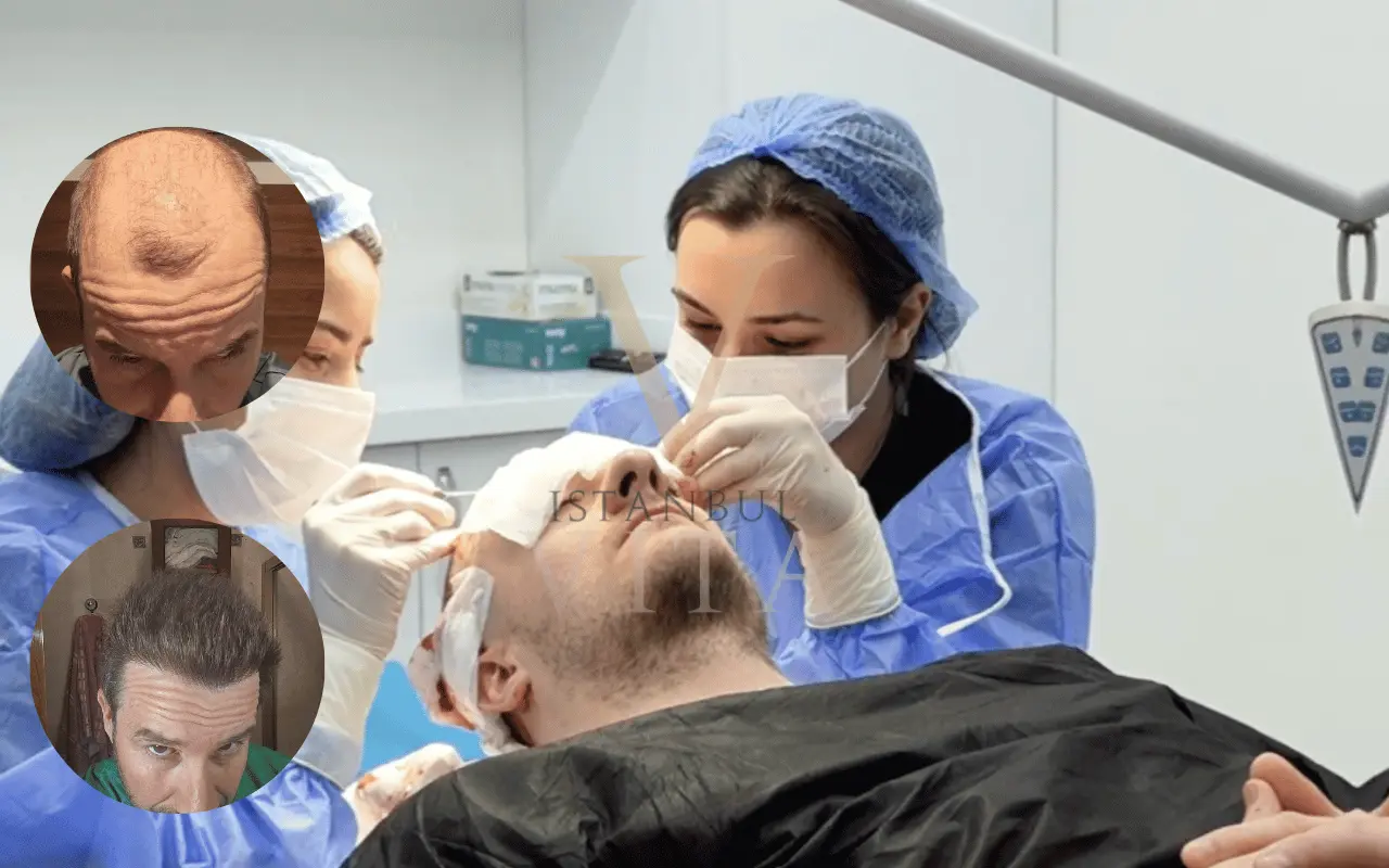 a doctor is performing hair transplant