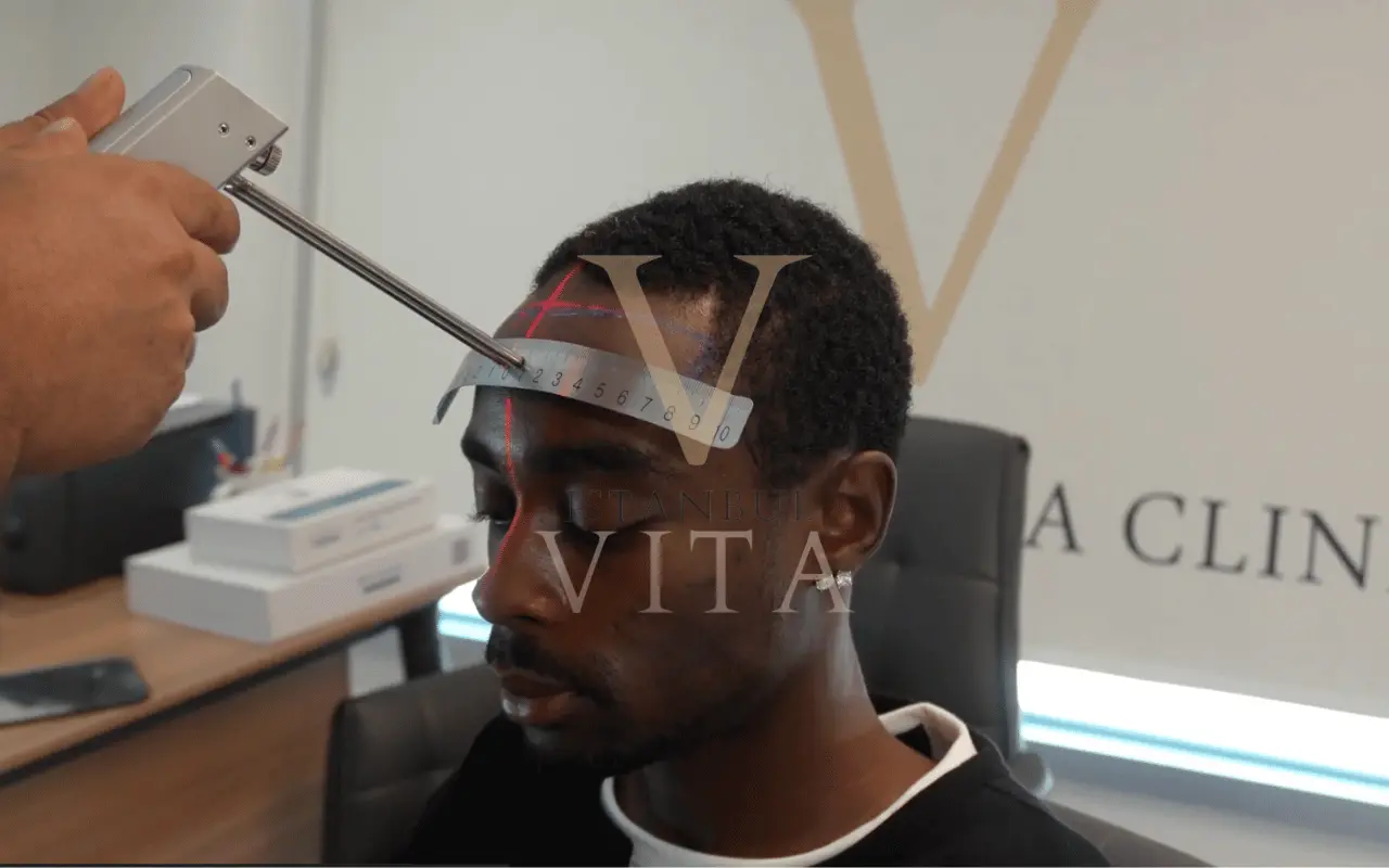 black hair transplant