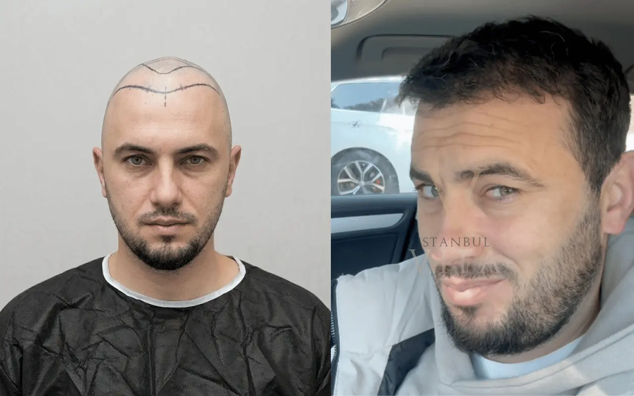a man with before and after hair transplant results 