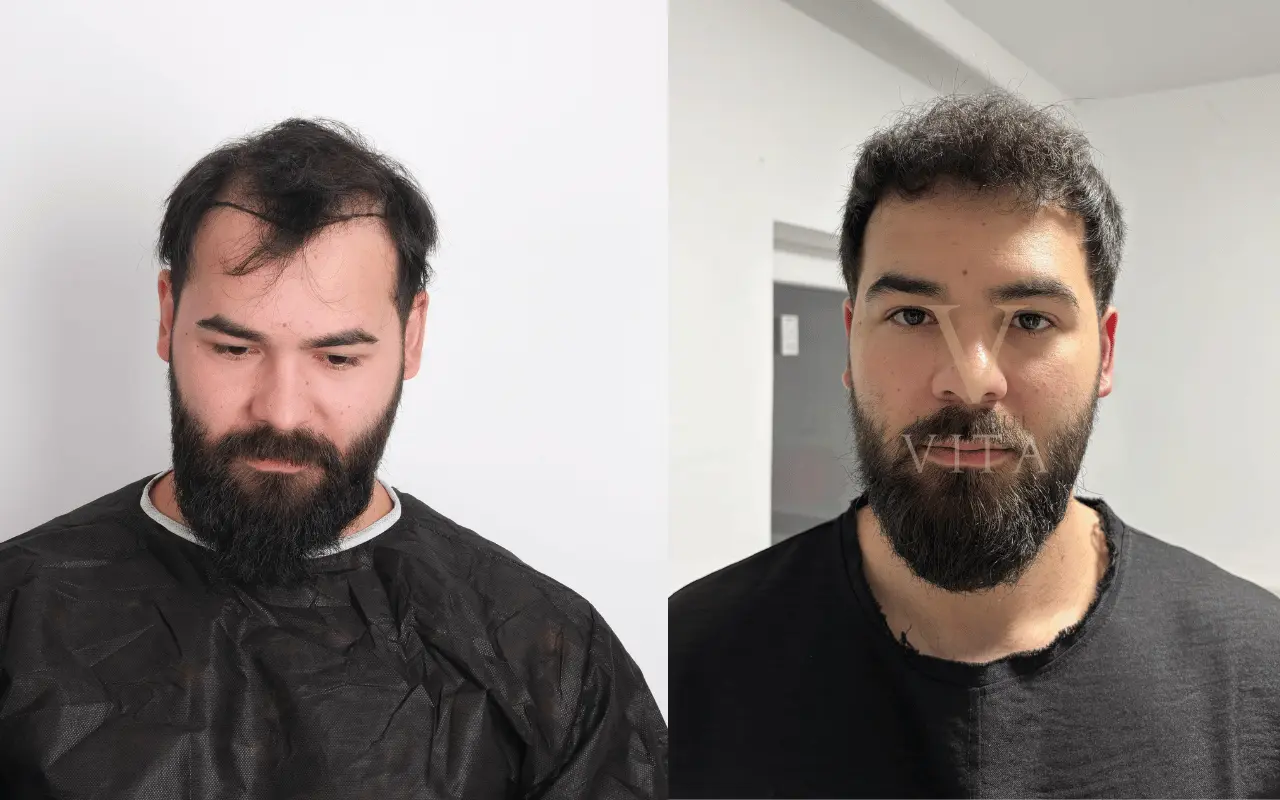 a man with hair transplant before and after results