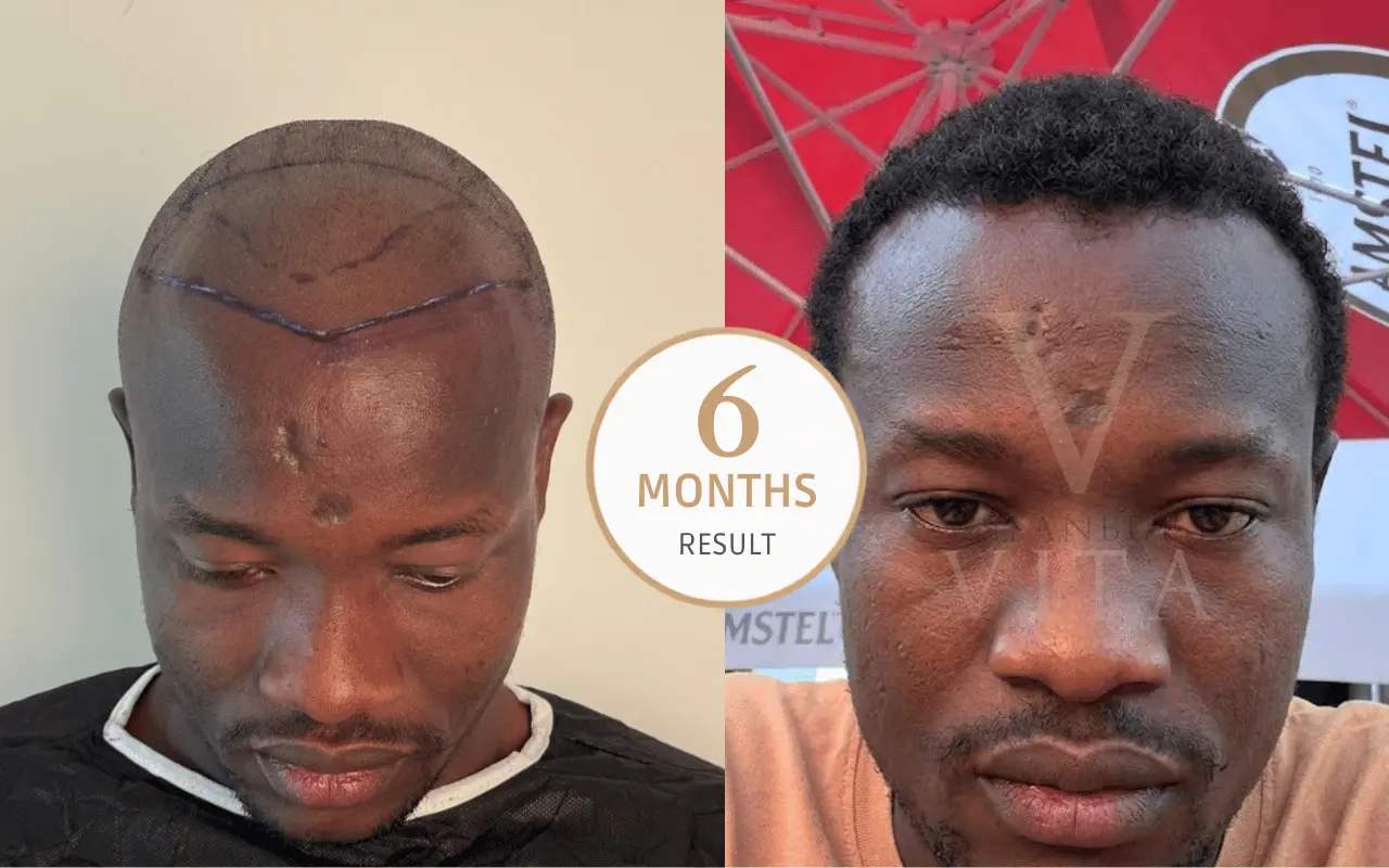 afro hair transplant