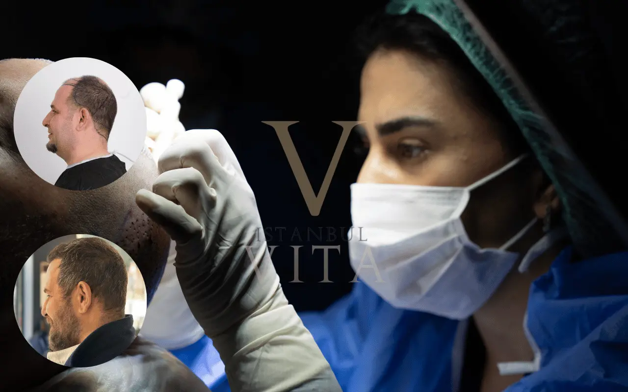 the doctor is doing hair transplant with choi implanter pen