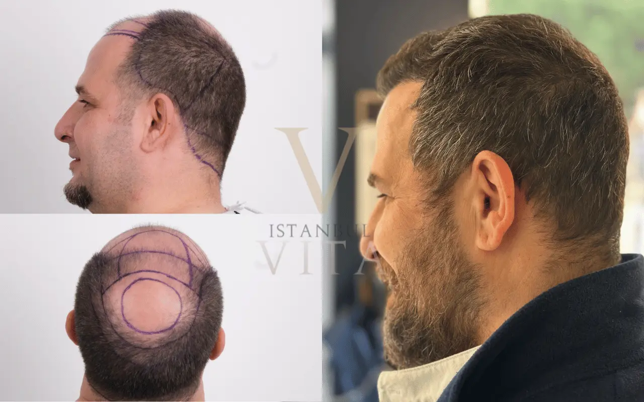 before and after resuts of hair transplant
