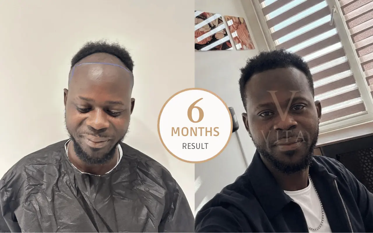 afro hair transplant