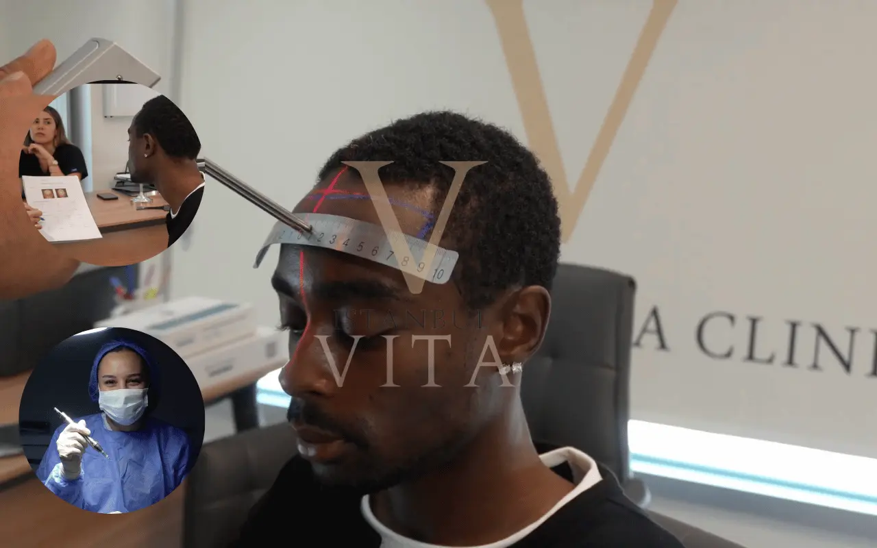 doctor-led hair transplant
