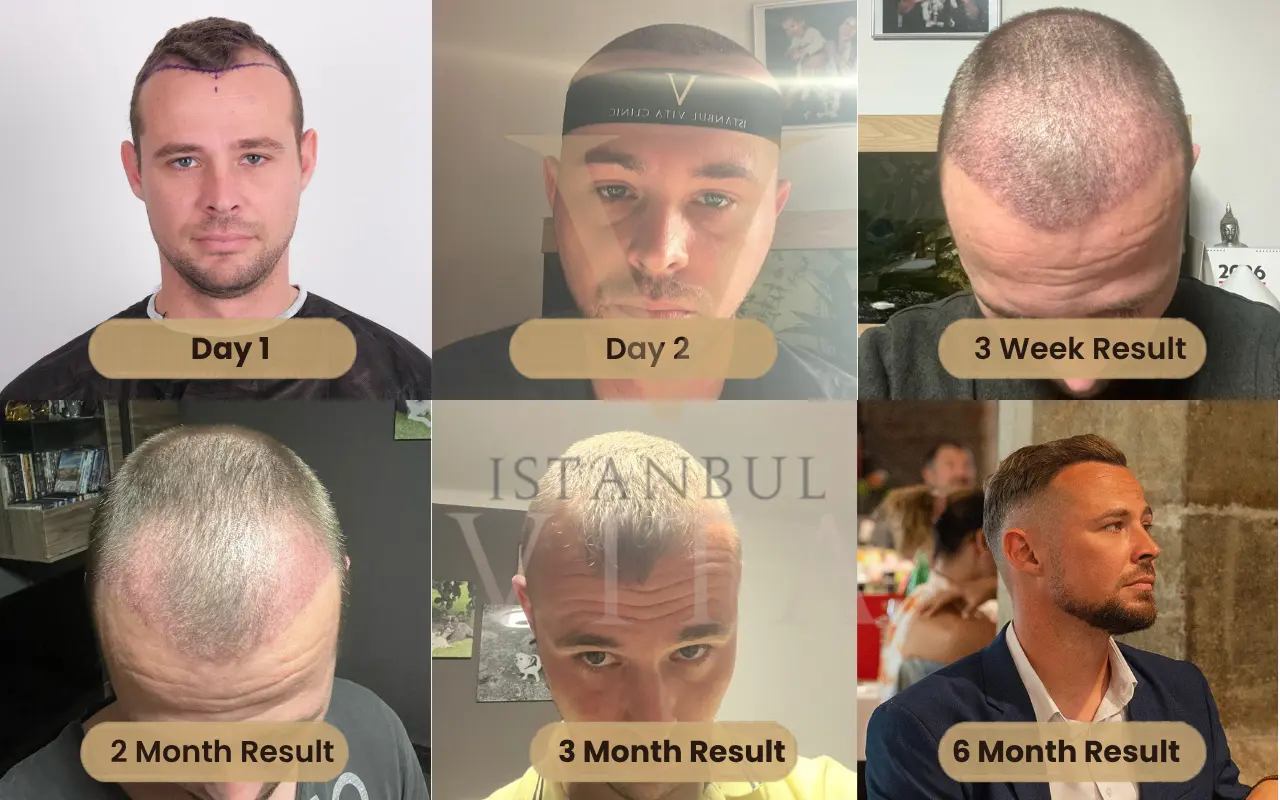 12 months visible results after hair transplant