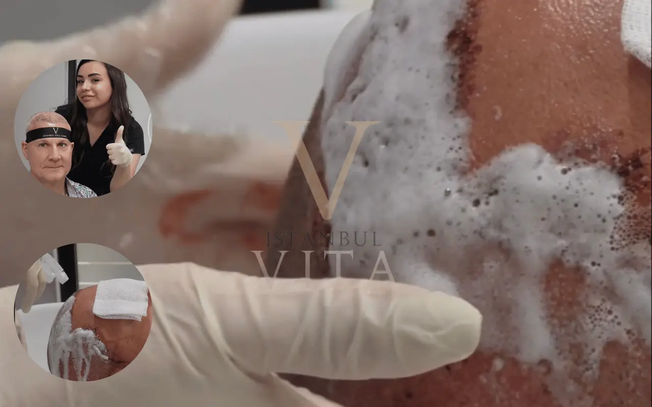 doctor is head washing after a hair transplant