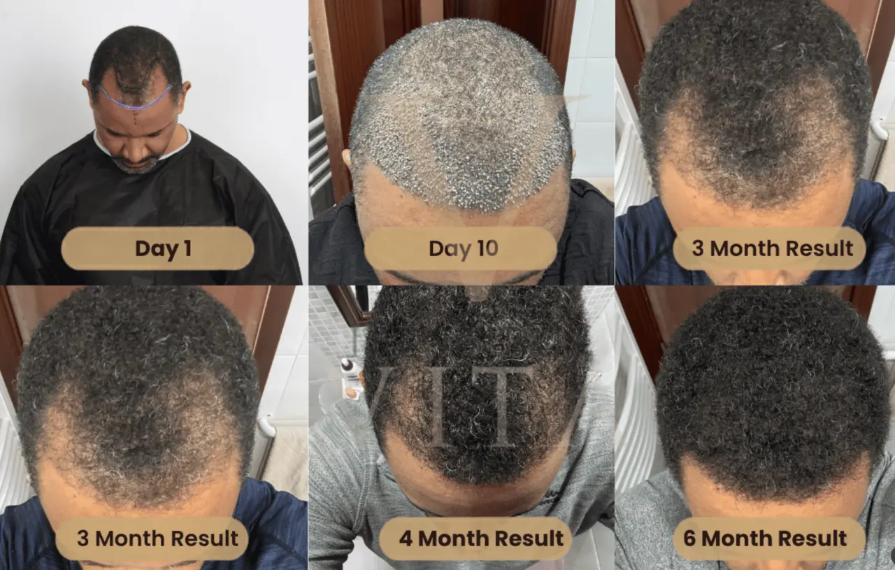 hair transplant recovery process