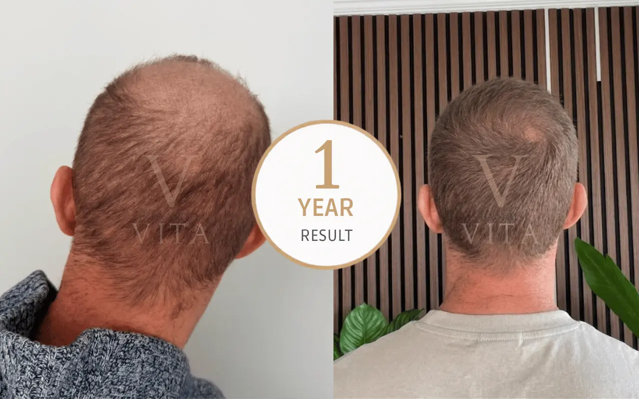 1 year hair transplant result review