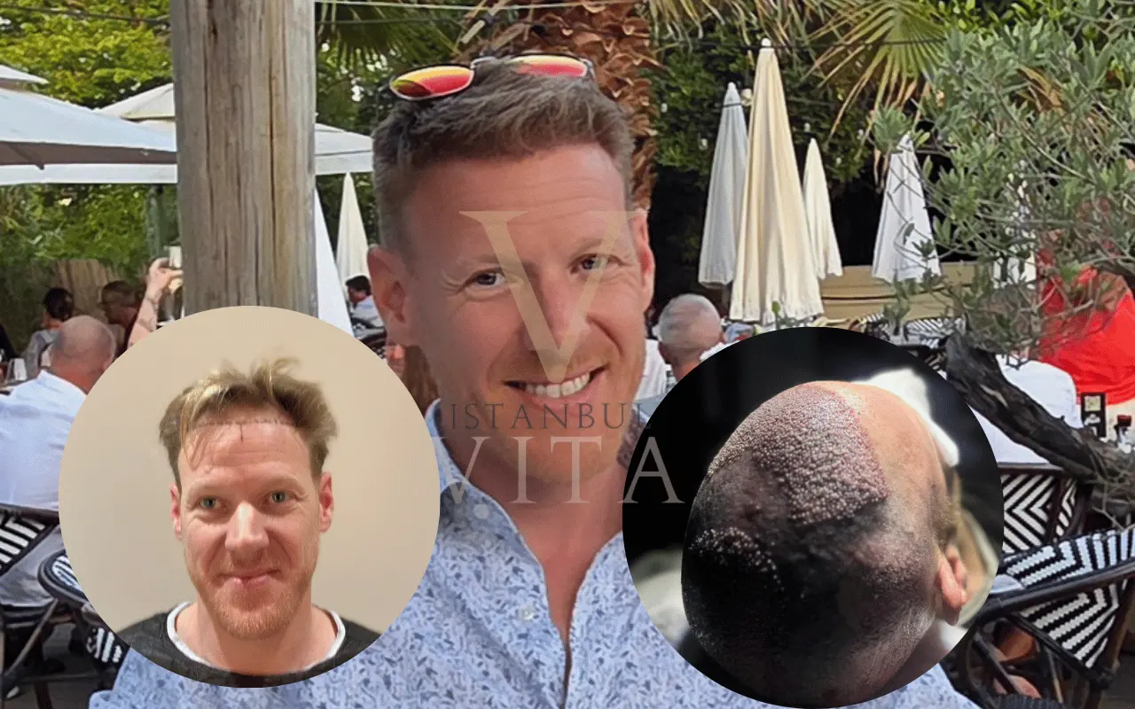 graft extraction pic and after transplant results
