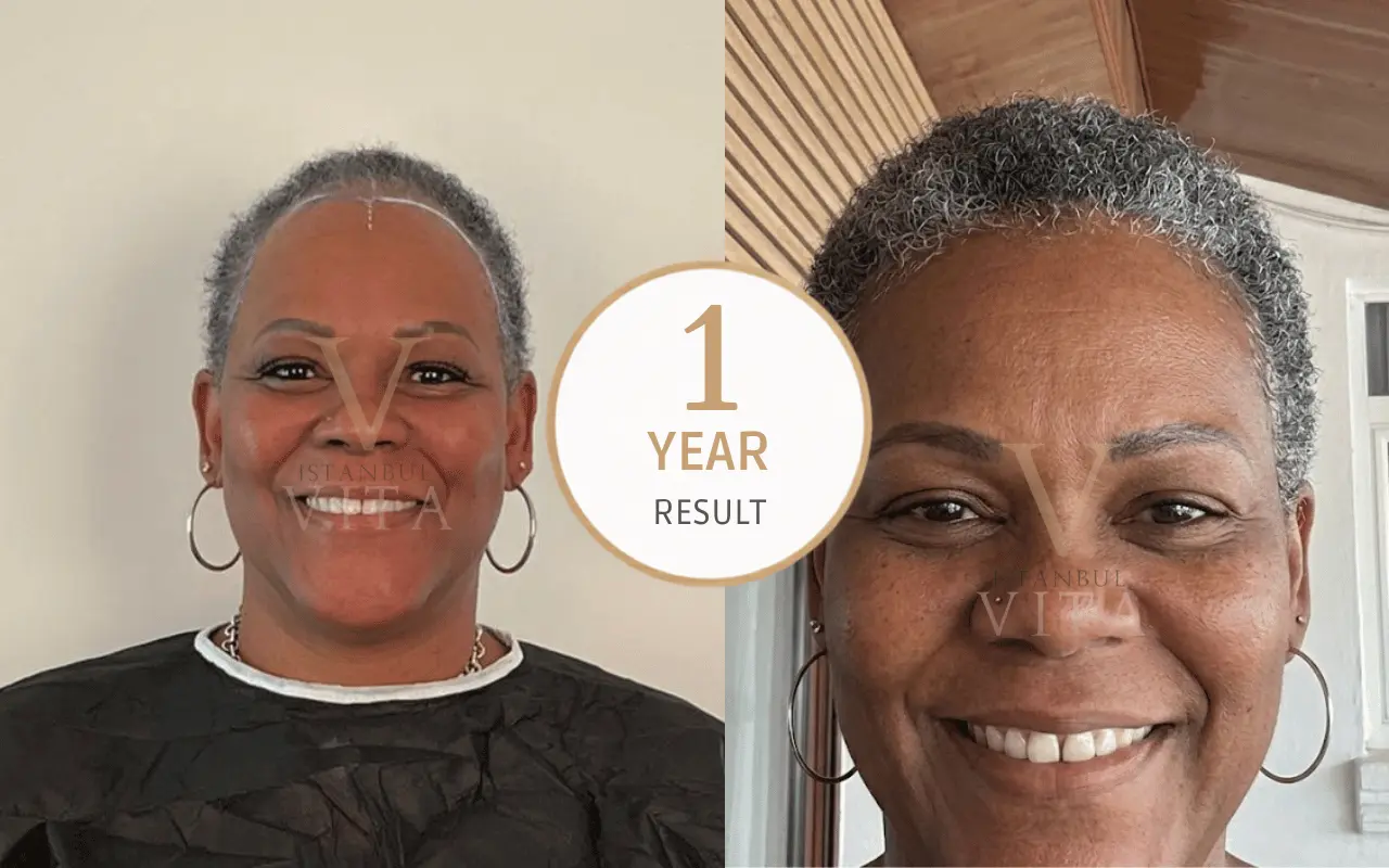 Afro hair transplant