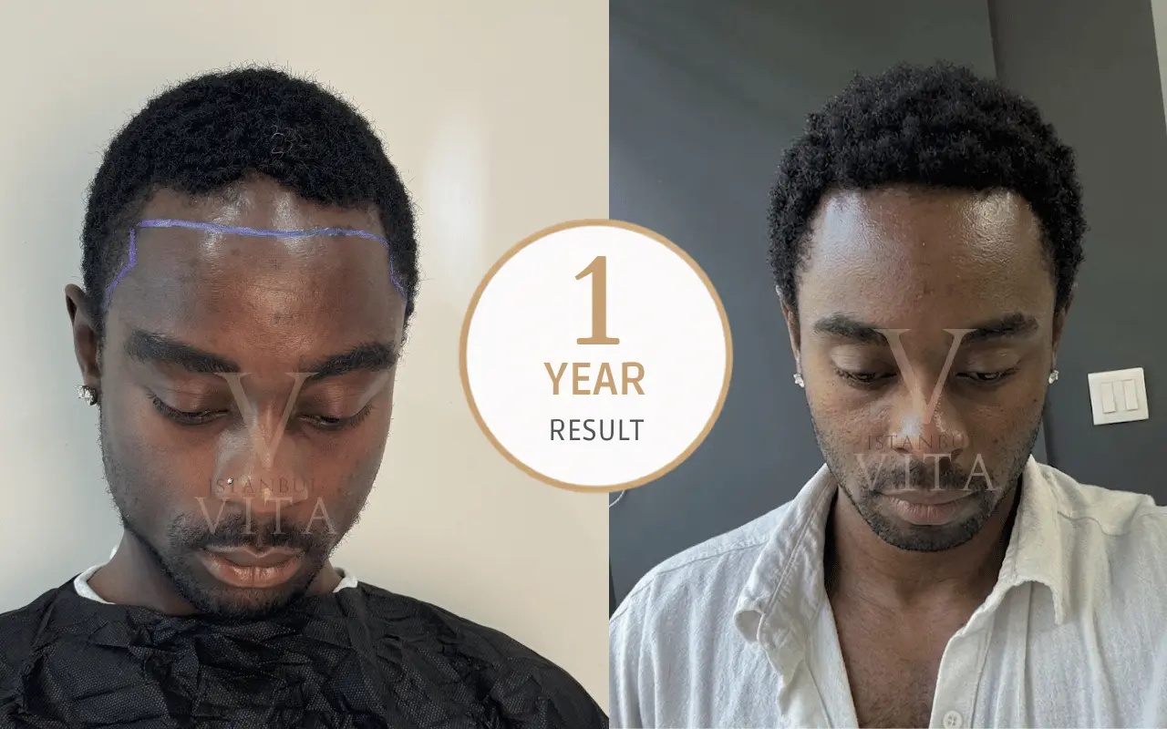 afro hair transplant before after