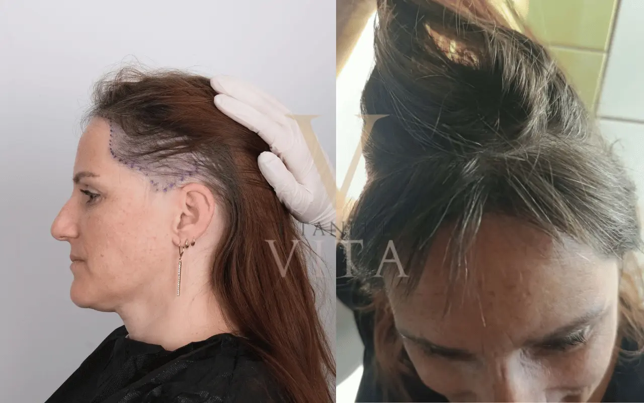 different pattern hair loss transplant of a woman before and after results 