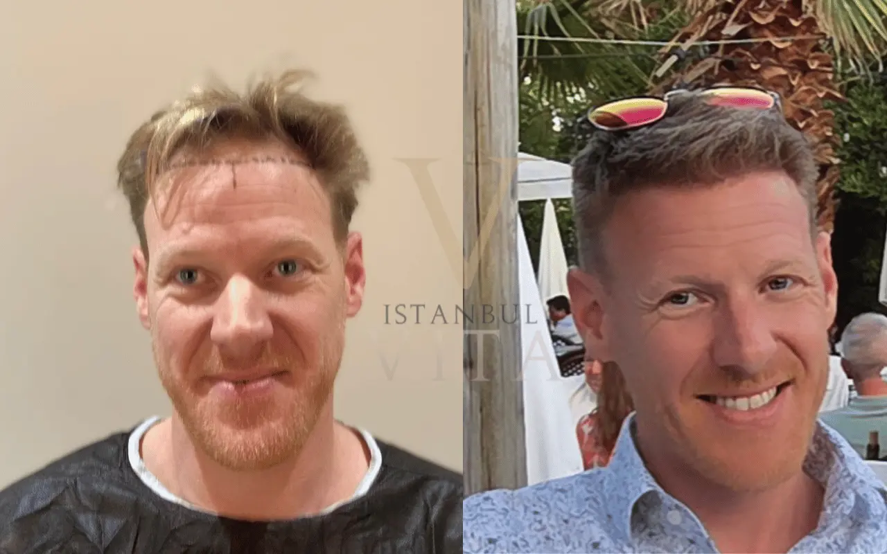 before and after hair transplant result of a UK patient