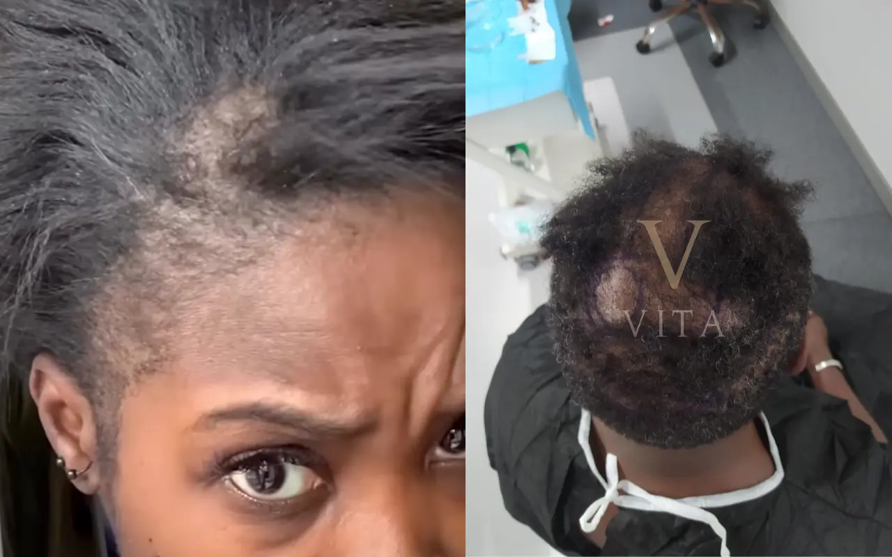 frontal fibrosing alopecia(FFA)