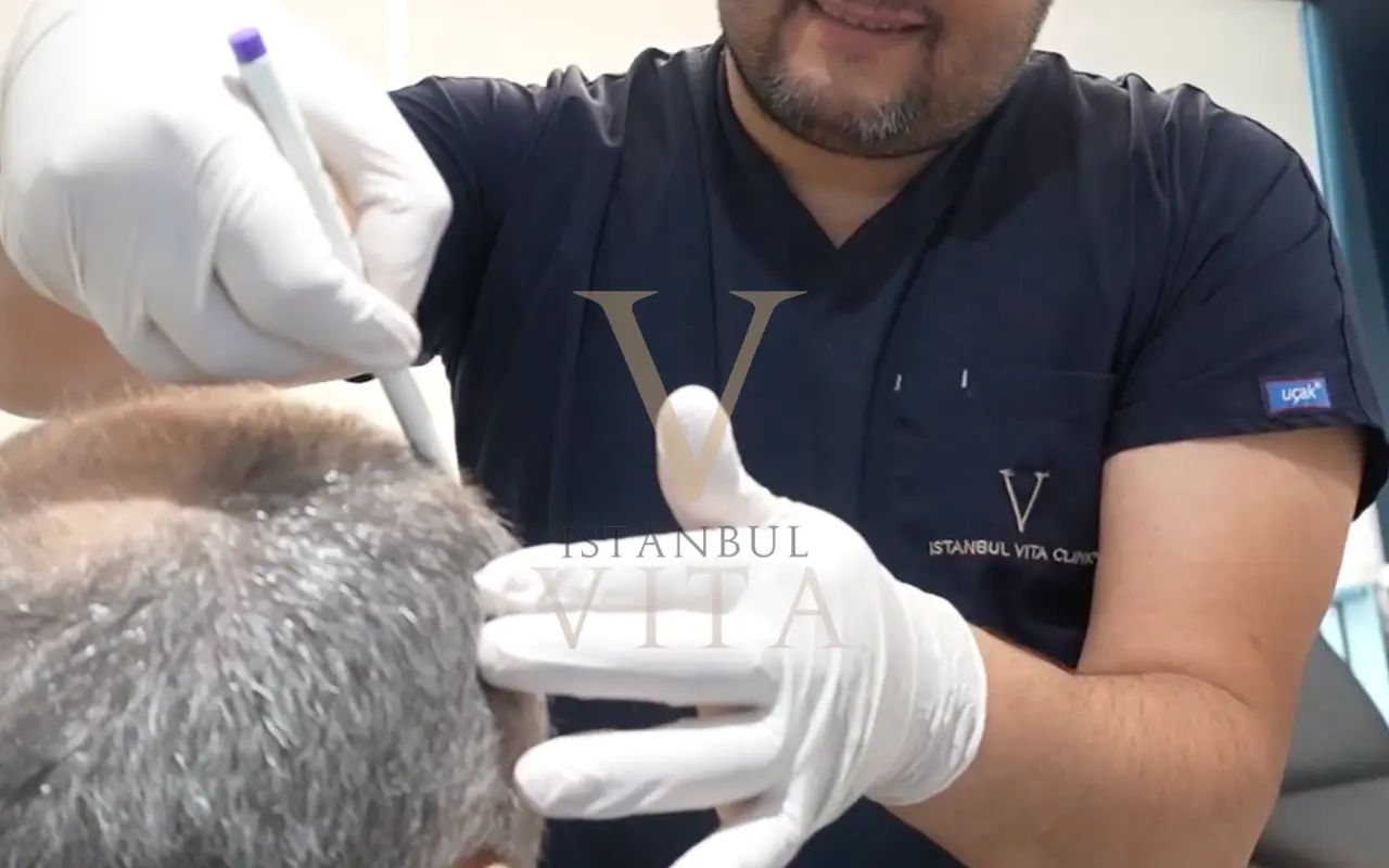 Hair Transplant for Grey Hair