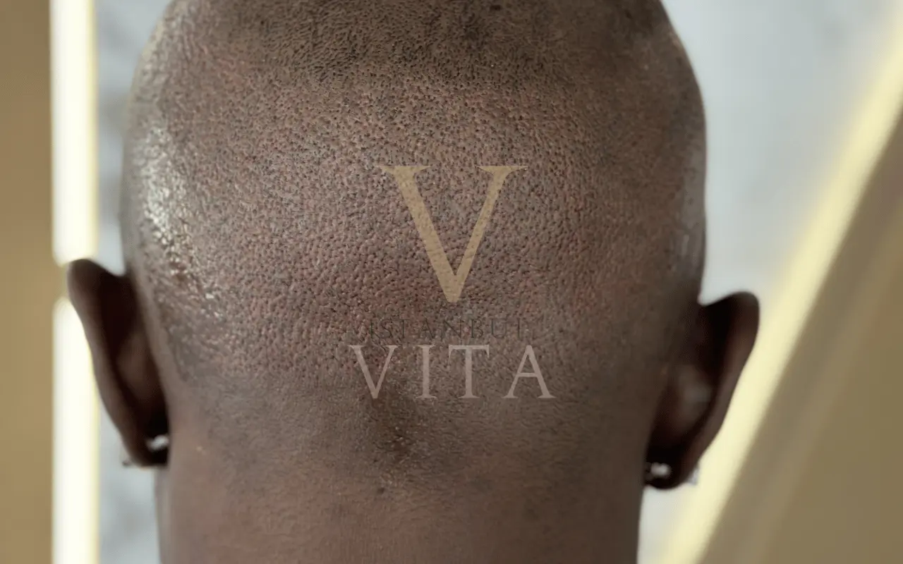 Donor Area in Afro Hair 