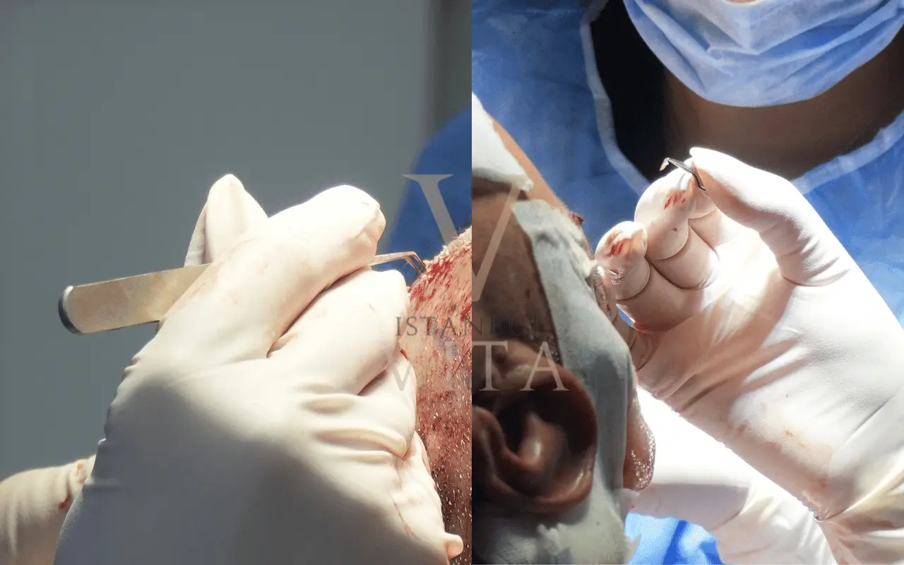 doctor is carefully picking the grafts for hair transplant process