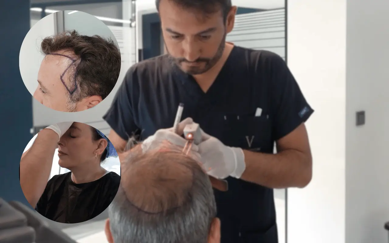 a doctor is performing hair transplant and also the before after results