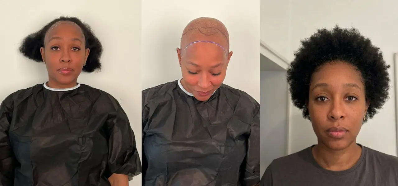 Afro Hair Transplant for Black Women