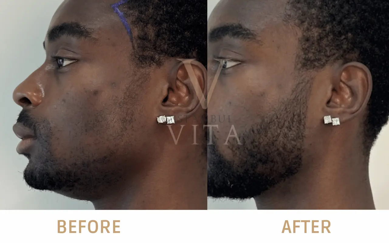 Afro Beard Transplant