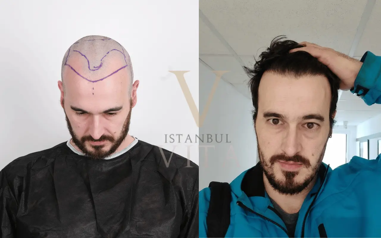 a person with before and after hair transplant results 