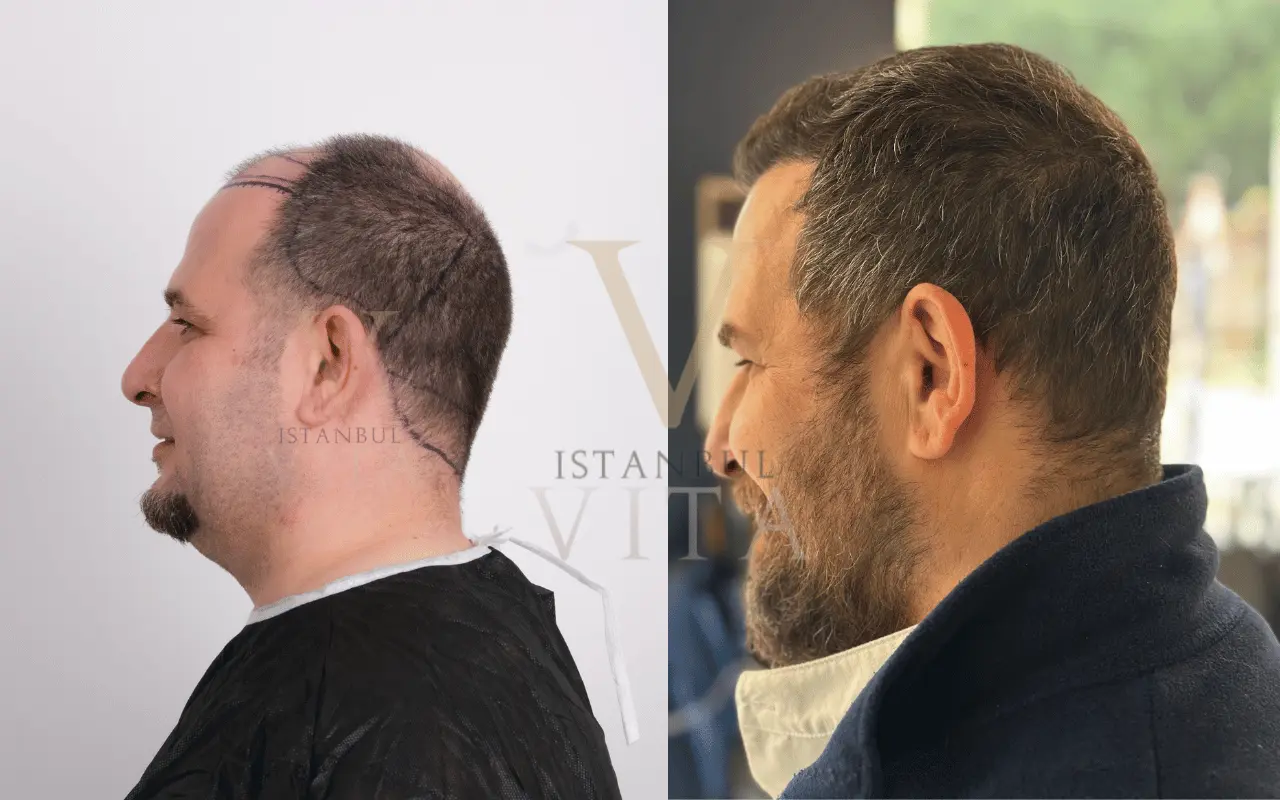 before and after hair transplant results 