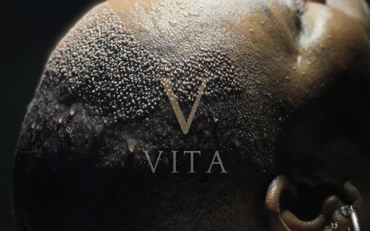 a close picture of grafts extraction 