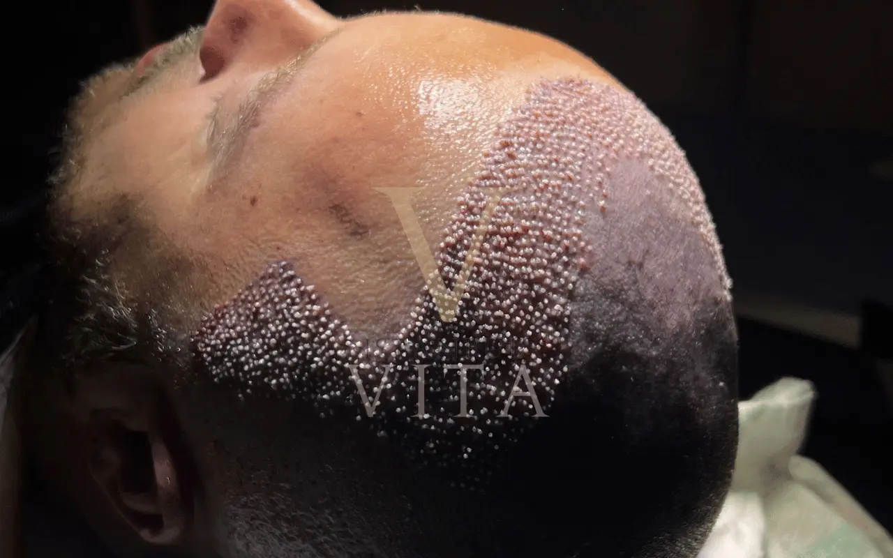 a closeup of graft extraction of a patient 