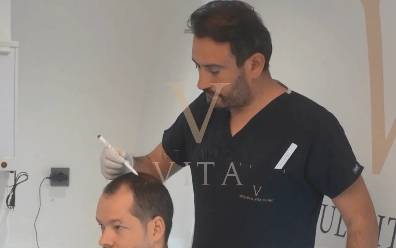 No-Shave Hair Transplant