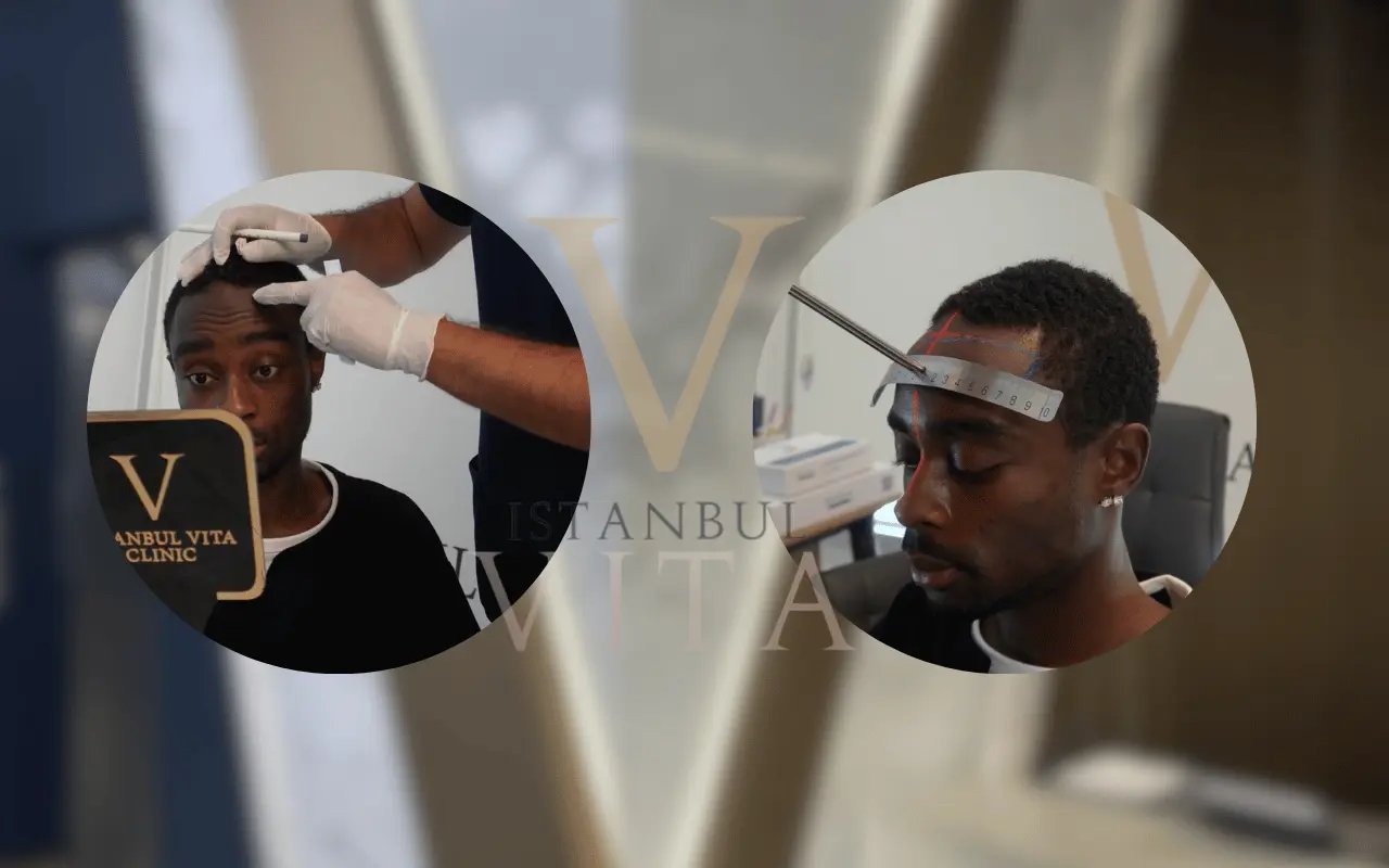 a patient came for afro hair transplant consultation 