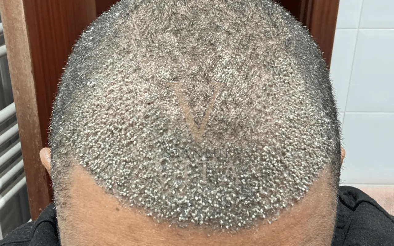 Scabs Form After a Hair Transplant