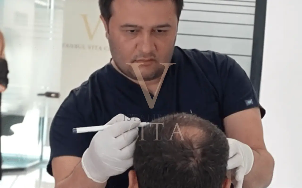 channel opening in hair transplant