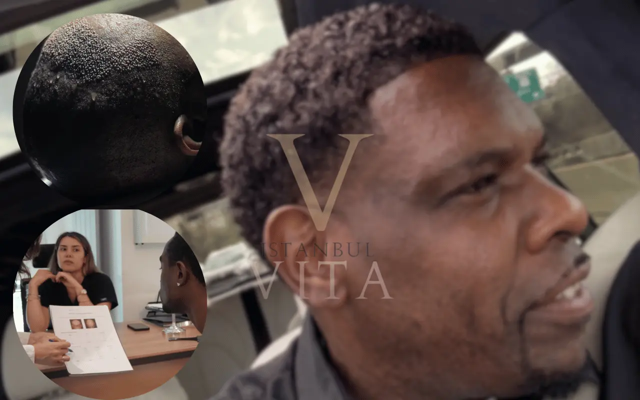 afro hair transplant recovery tımeline