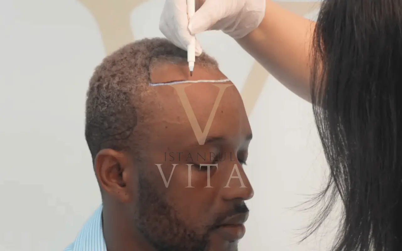 Transection Risk in Afro Hair Transplant