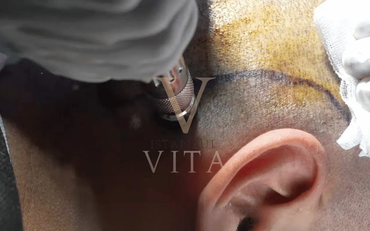 a closeup of hair transplant procedure