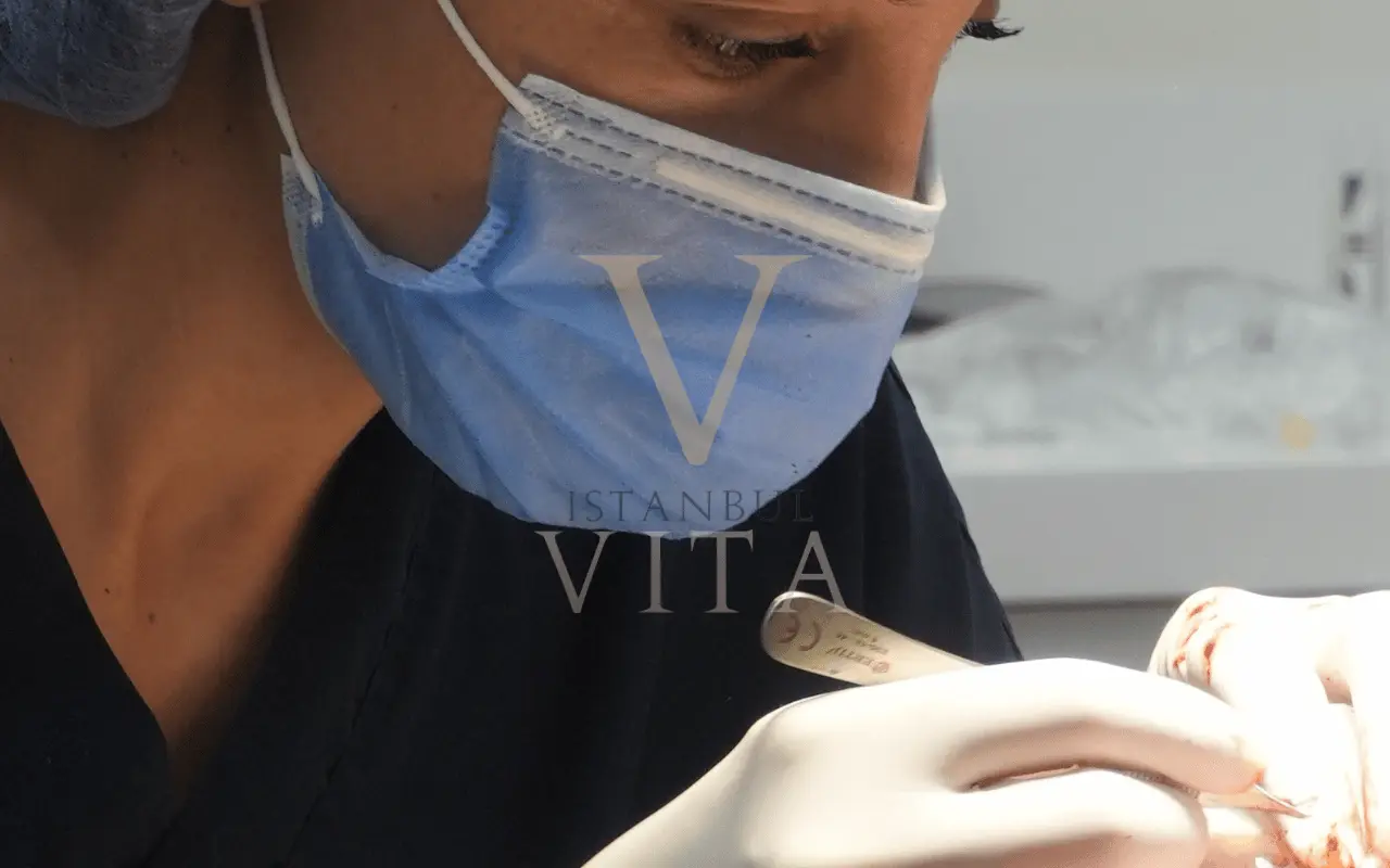 closeup of doctor doing hair transplant process