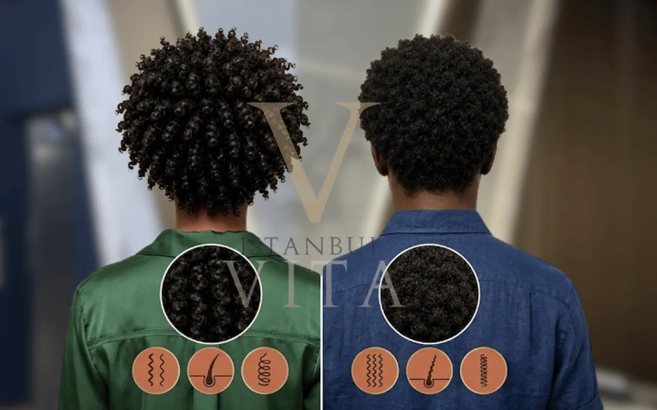 Curl pattern preservation in hair transplant